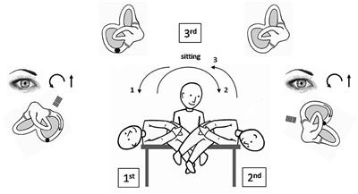 Congruous Torsional Down Beating Nystagmus in the Third Position of the Semont's Maneuver in Patients Treated for Canalithiasis of Posterior Semicircular Canal Benign Paroxysmal Positional Vertigo: Its Significance and Prognostic Value